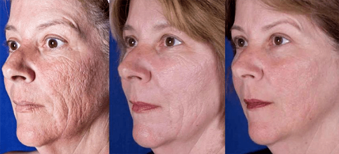 Resulta pagkatapos ng laser facial pamamaga ng pagpapabata ng balat